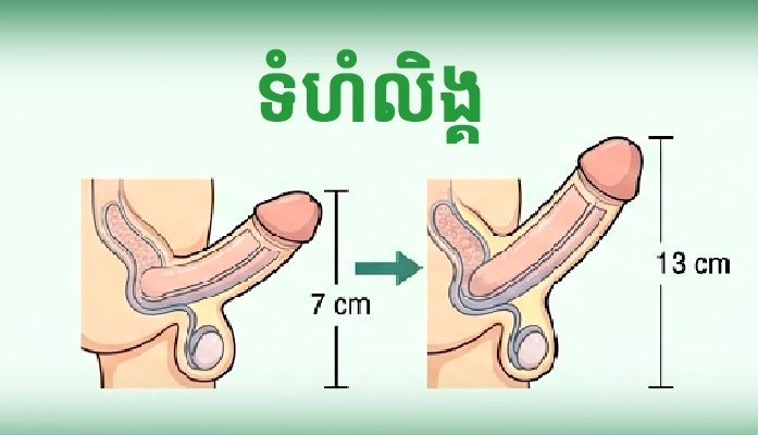 ទំហំលិង្គមាន​ភាព​ខុស​គ្នា​យ៉ាងដូចម្តេចខ្លះ?