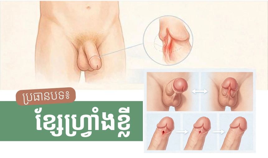 ប្រធានបទ៖ ខ្សែហ្វ្រាំងខ្លី